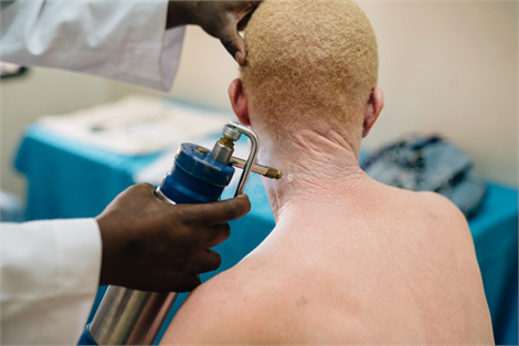 Patient with albinism receiving cryotherapy